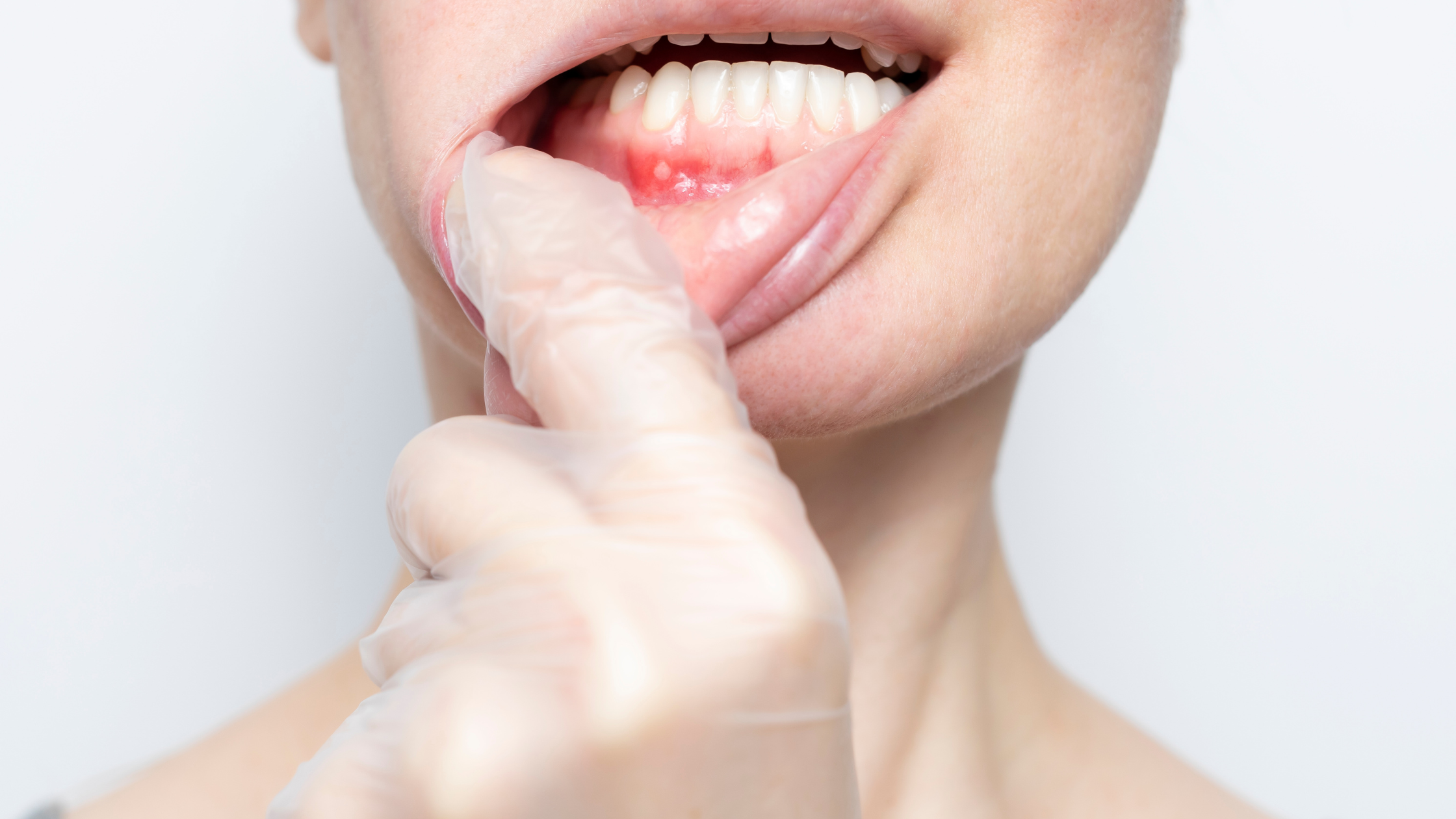 Mouth Ulcer? Causes, Prevention, and Treatment